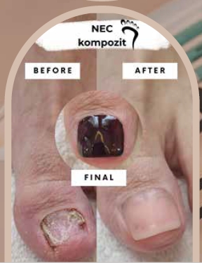 NEC kompozit — rekonstrukcija nokta (before/after)
